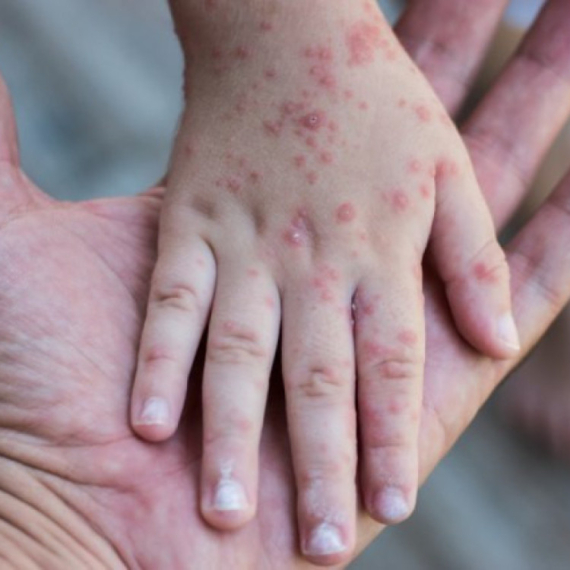 Najnoviji podaci o morbilama u Srbiji: Epidemija se širi